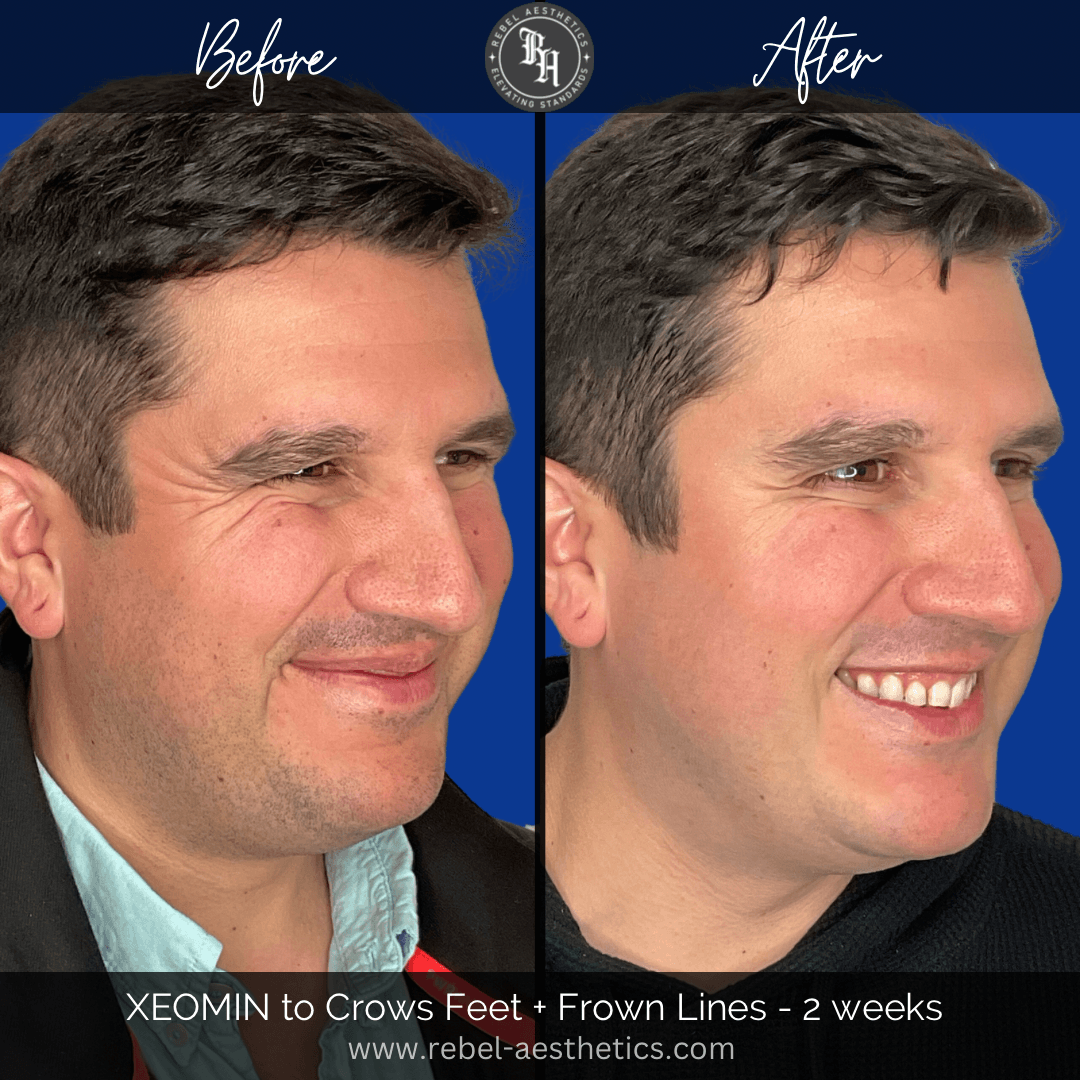 Before and after photos showing that Xeomin is an effective way to fix crows feet and reduce and prevent eye wrinkles on skin of any age. 