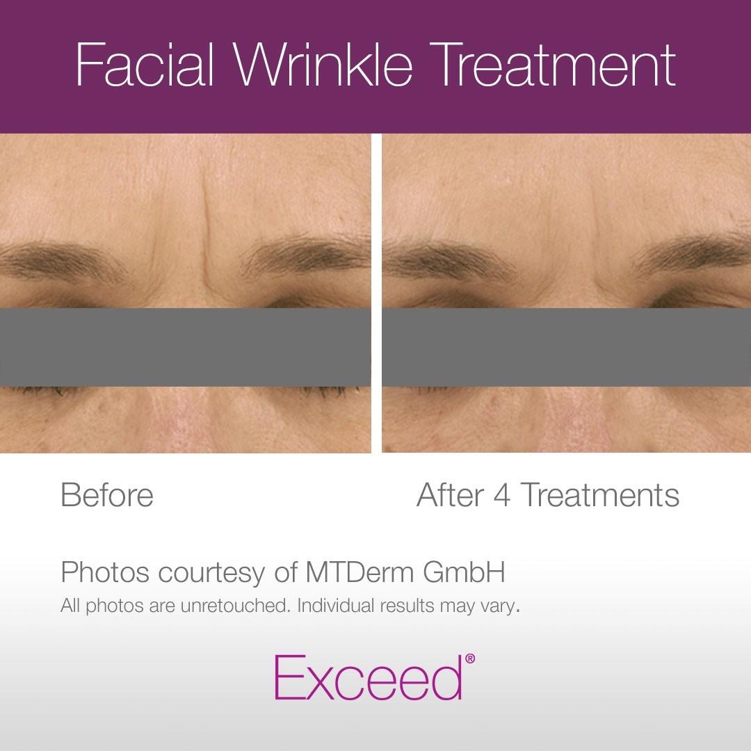 Side by side photos that show Exceed microneedling to be an effective facial wrinkle treatment option for women and men looking for something that actually reduces fine lines and wrinkles on the face. Before and after photos show results from microneedling after 4 treatments to effectively reduce elevens wrinkles