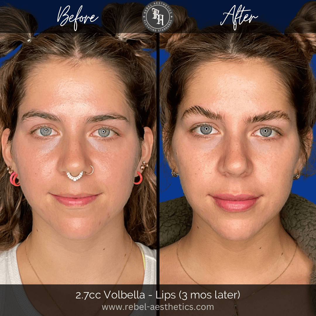 Side by side lip filler before and after photos of a young woman who received Volbella treatment. Lip fillers or lip injections are a long-lasting solution for fuller lips such as those shown in this photo.