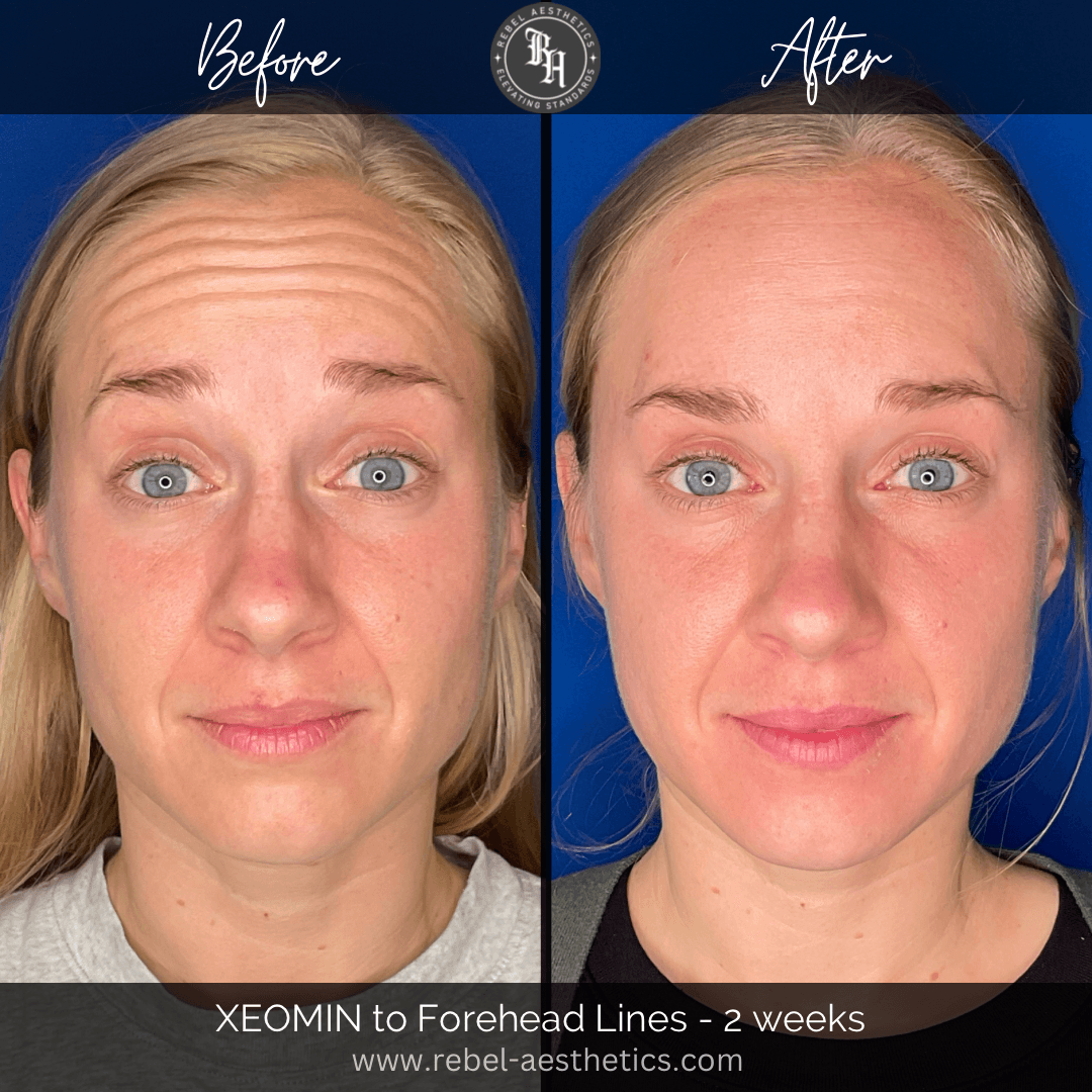 Before and after Xeomin injections for forehead wrinkles, showing that in two weeks this treatment proved to be an effective way to reduce forehead expression lines