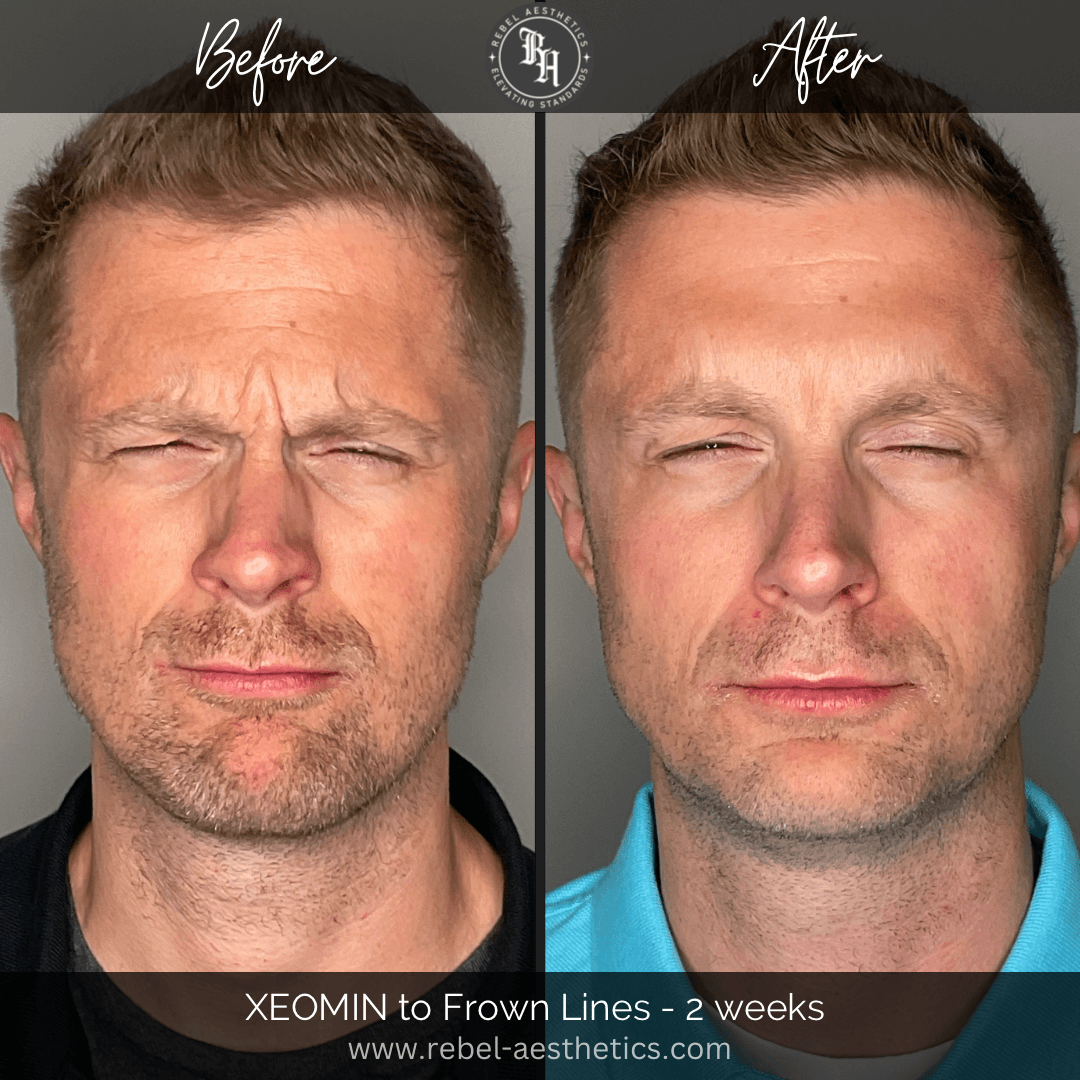 Before and after comparison photos of a man treated with Xeomin for frown lines and wrinkles between the eyebrows, showing that tox treatment for men is an effective option