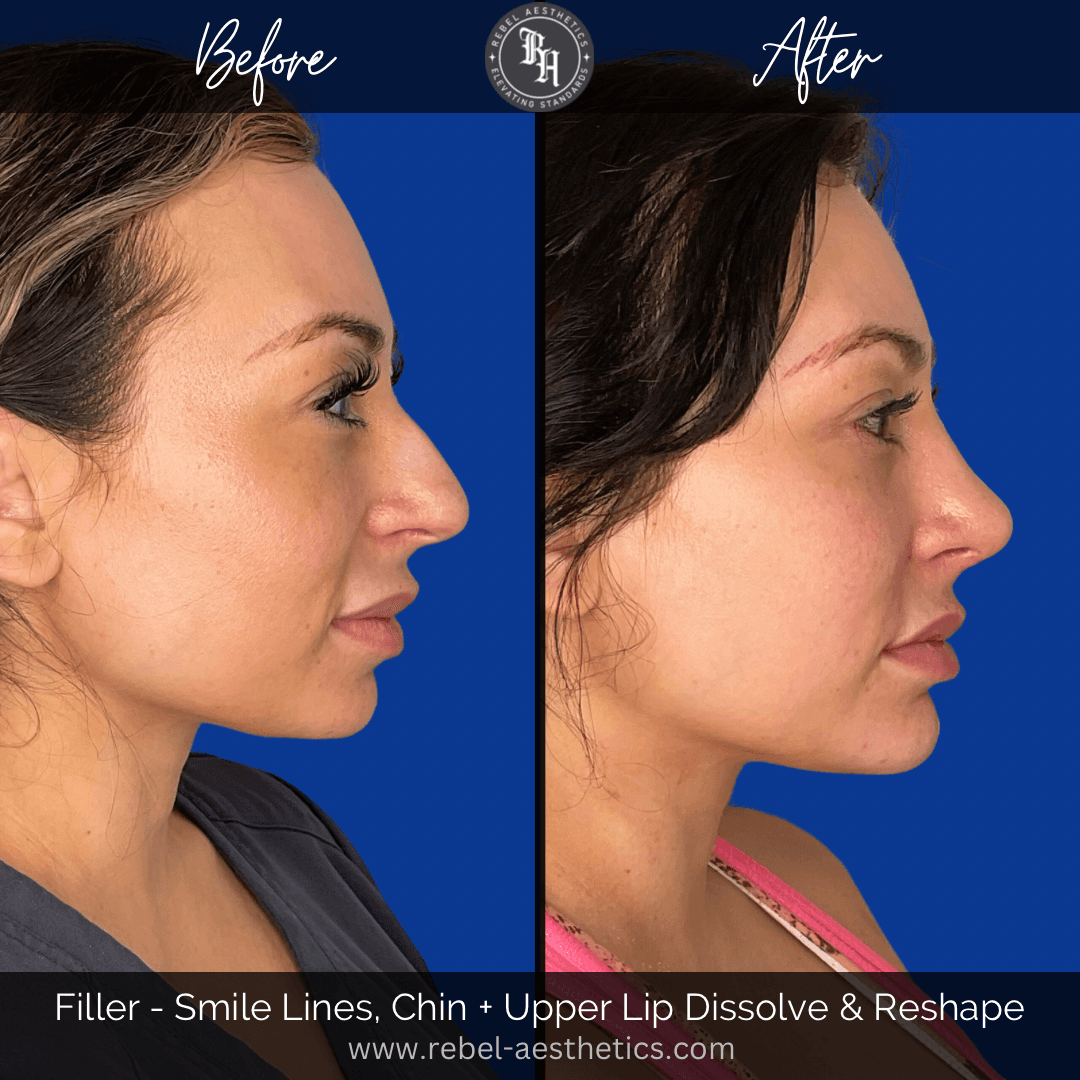 Before and after photos of Juvederm filler results show a side by side comparison of the effectiveness of Juvederm treatment for reversing filler migration, reducing smile lines, enhancing the chin, and reshaping the lips. 