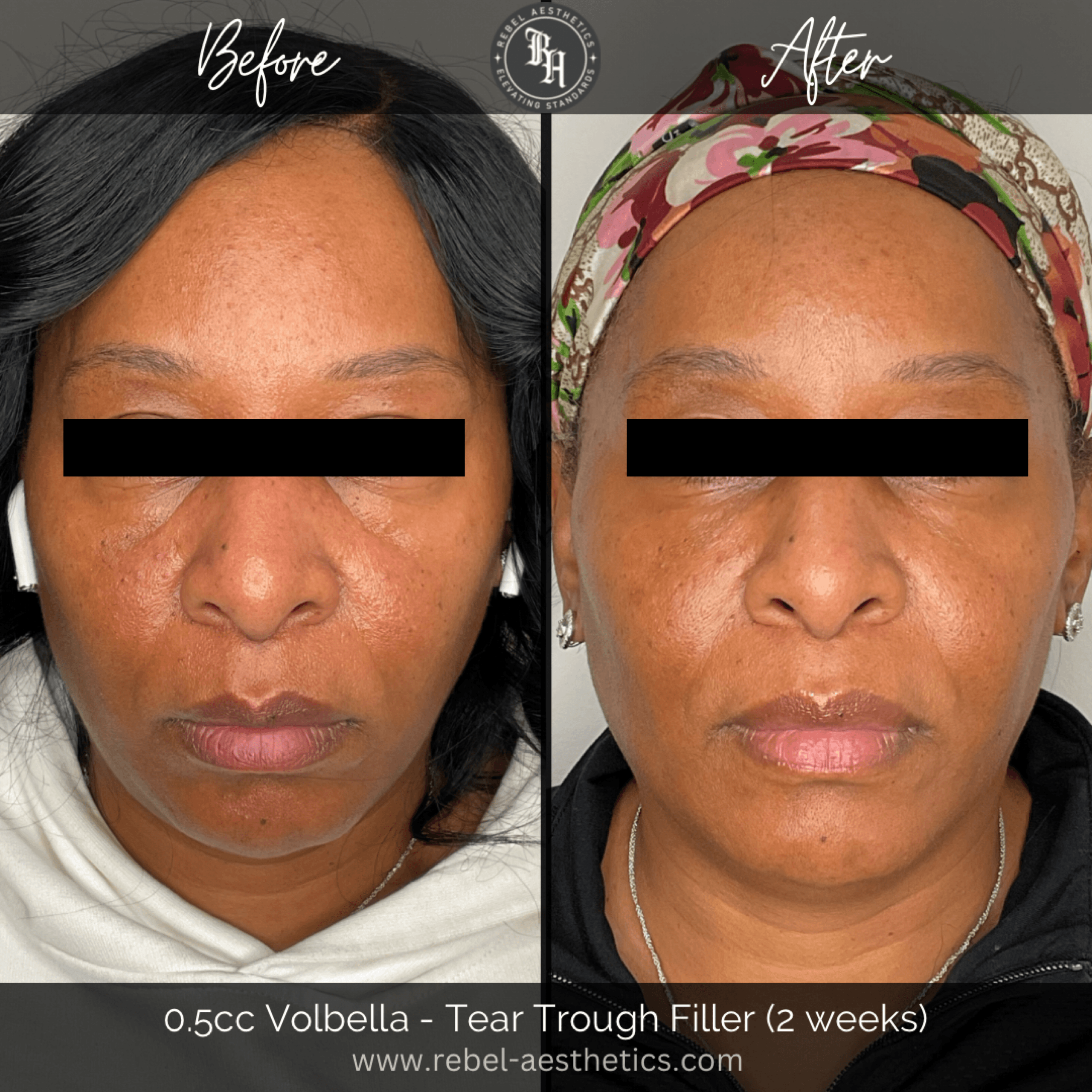 Juvederm Volbella filler is injected under the eyes or tear troughs to reduce hollows, shadows, and sunken appearance. This helps patients appear more refreshed and well-rested.