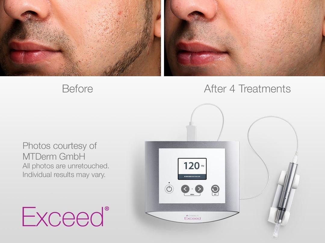 Two photos side by side along with the Exceed microneedling device, showing what microneedling can do for skin. The man in the photos has been shown to improve acne scars with a device that can restore skin health in men and women