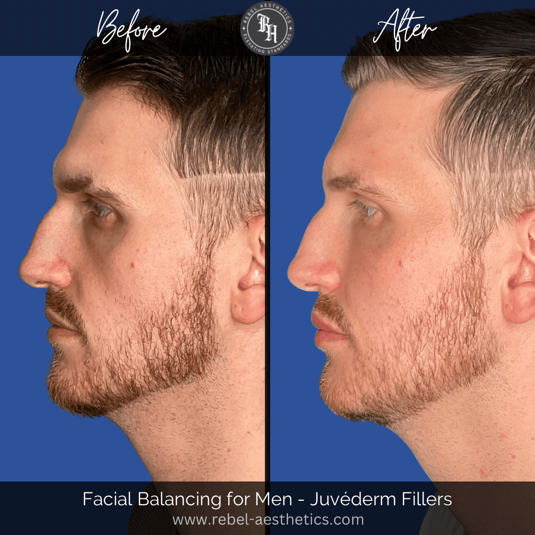 Before and after showing a side by side comparison of a male patient who received cheek filler, lip filler, chin filler, and jawline filler