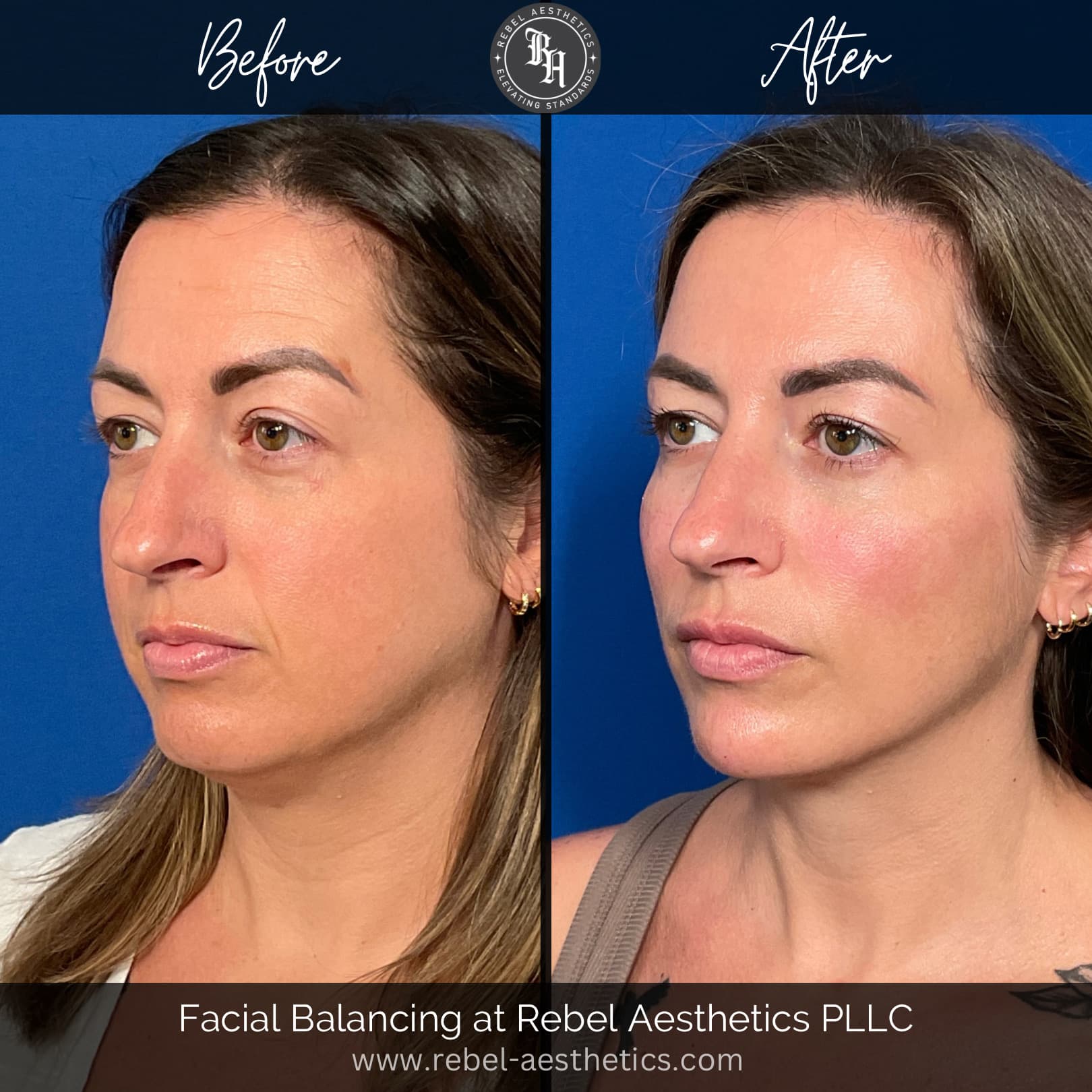 Facial balancing female patient at Rebel Aesthetics who received dermal filler injections for cheeks, tear troughs, nasolabial folds, lips, chin and jawline